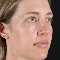 Rhinoplasty Before & After Patient #3291