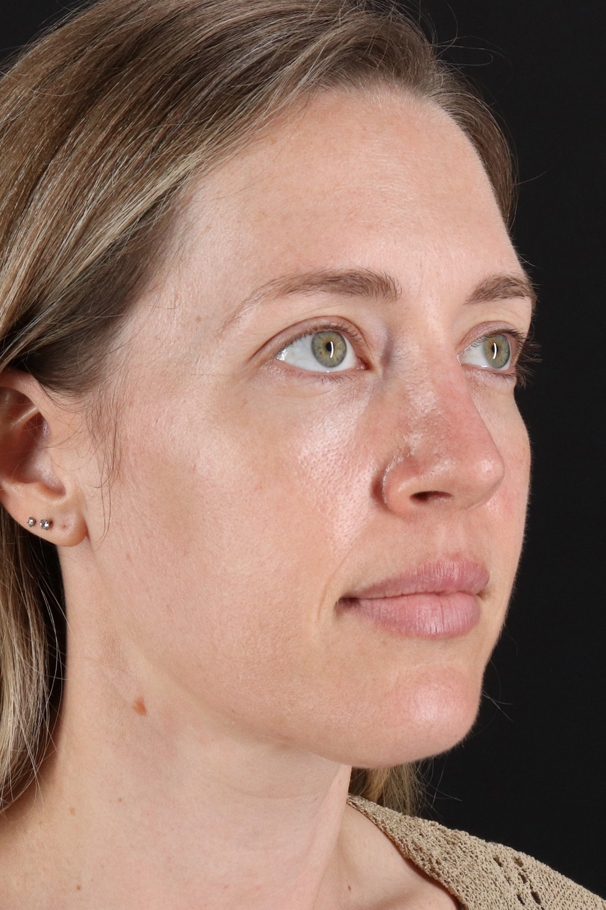 Rhinoplasty Before & After Patient #3291