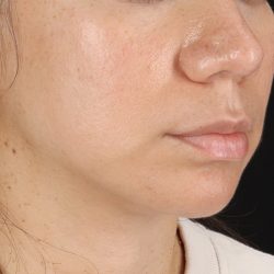 Chin Implant Before & After Patient #1540