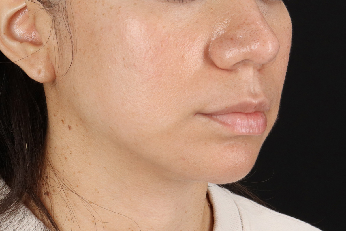 Chin Implant Before & After Patient #1540