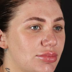 Rhinoplasty Before & After Patient #3104