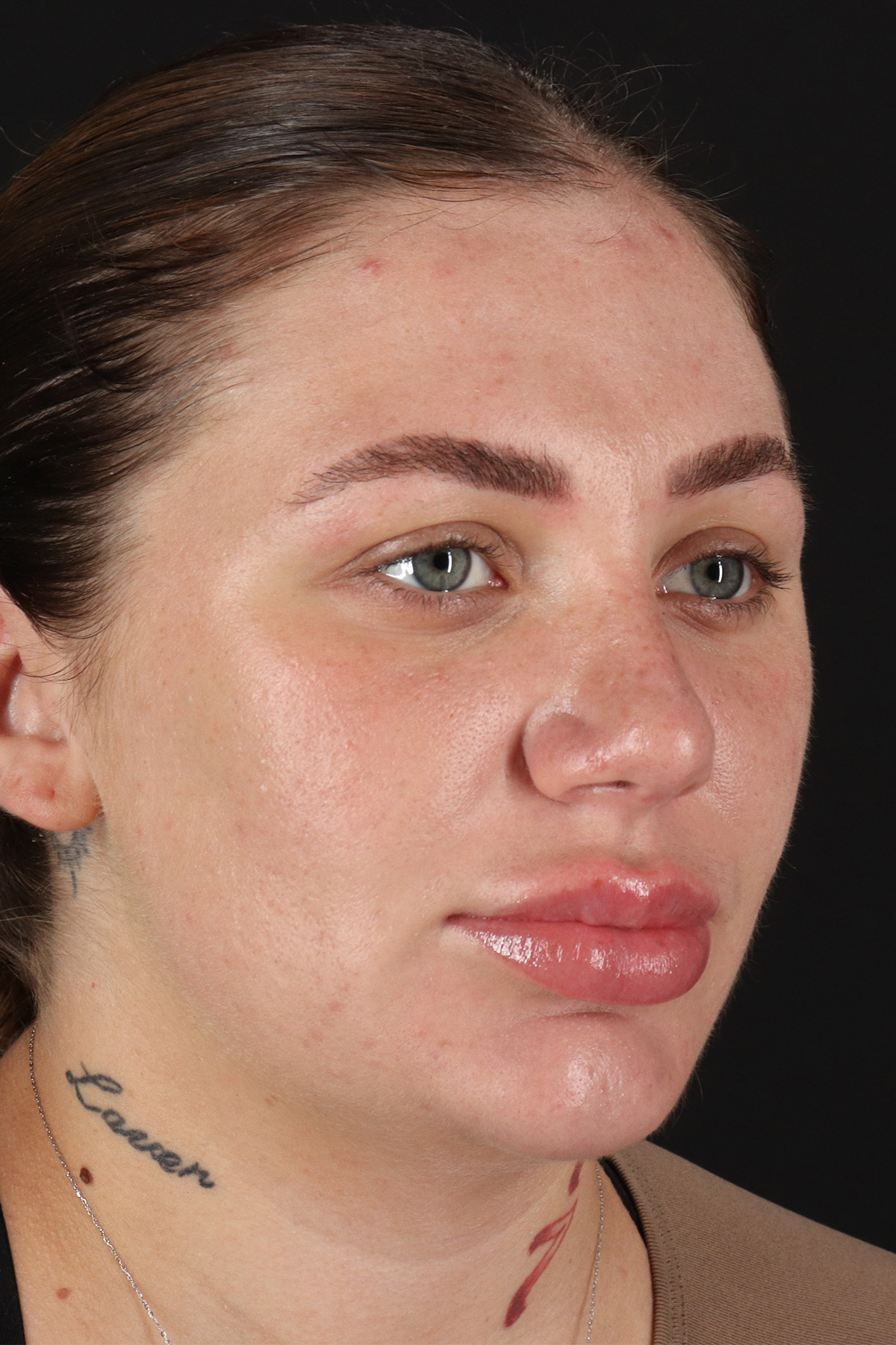 Rhinoplasty Before & After Patient #3104