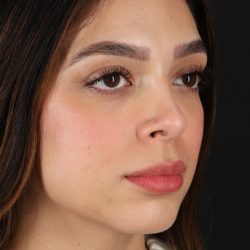Rhinoplasty Before & After Patient #3269