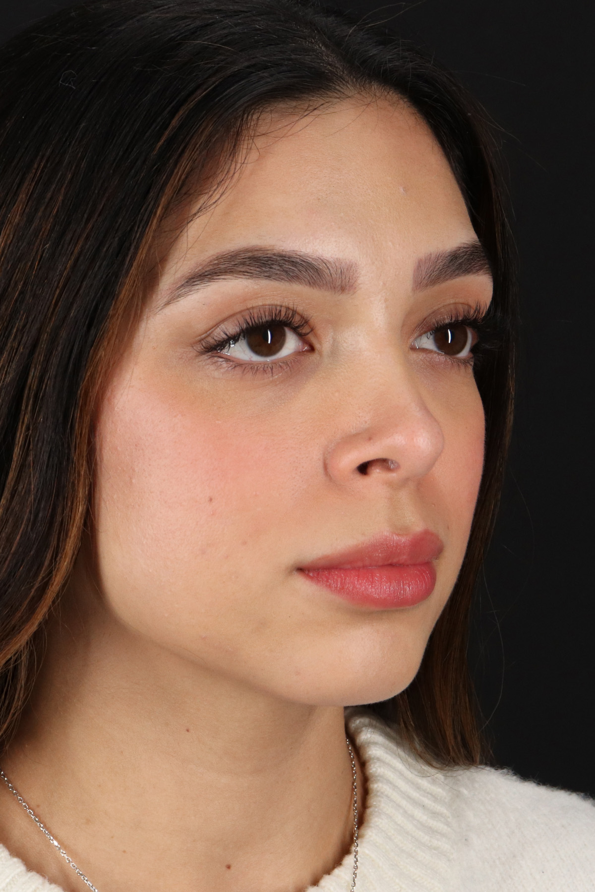 Rhinoplasty Before & After Patient #3269