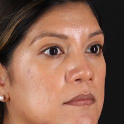 Rhinoplasty Before & After Patient #3181