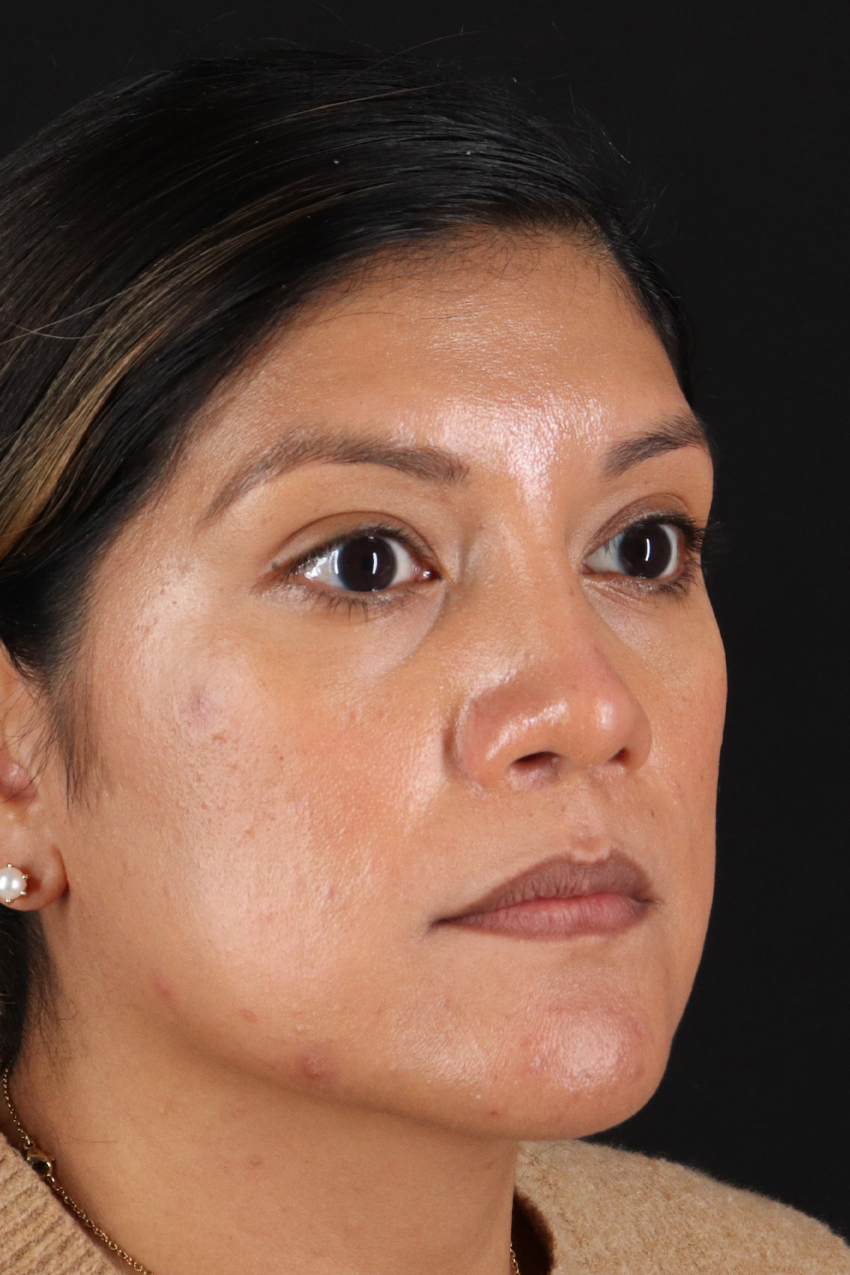 Rhinoplasty Before & After Patient #3181