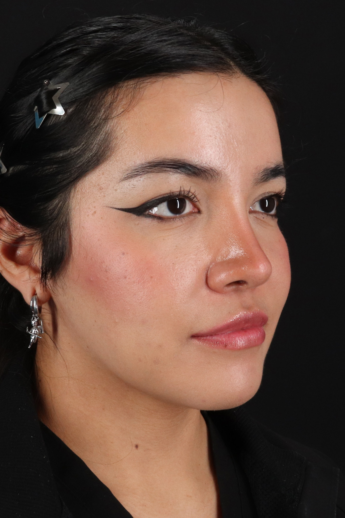 Liquid Rhinoplasty Before & After Patient #2265