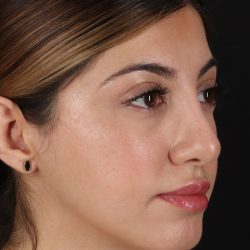 Rhinoplasty Before & After Patient #3214