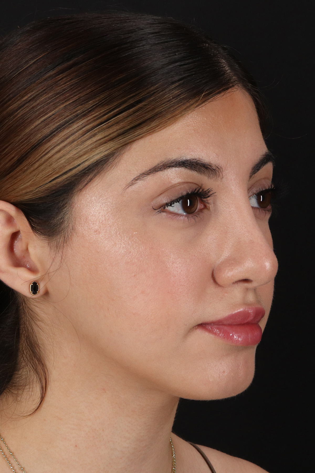 Rhinoplasty Before & After Patient #3214