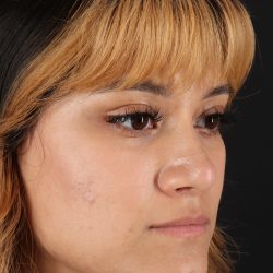 Rhinoplasty Before & After Patient #3038