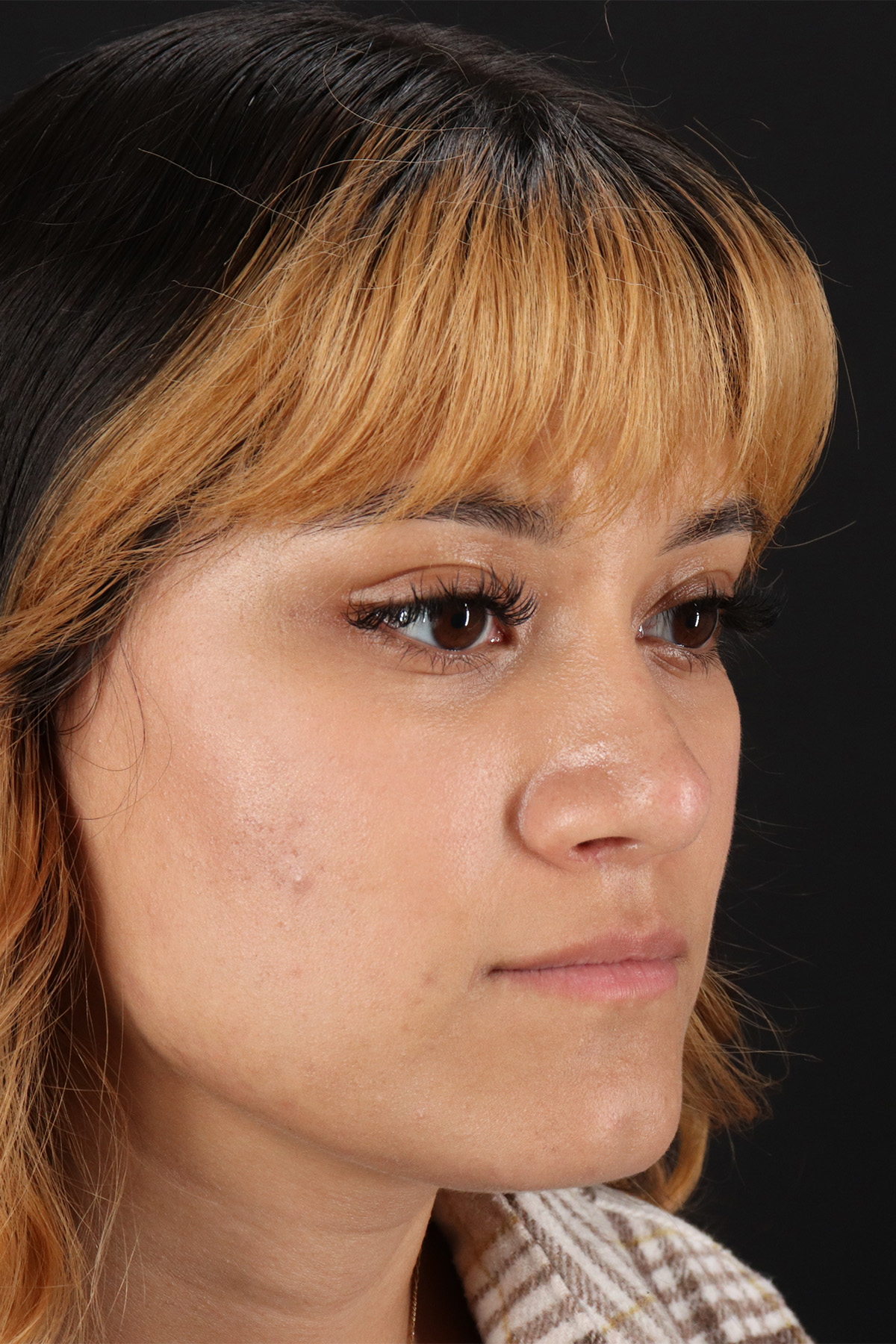 Rhinoplasty Before & After Patient #3038