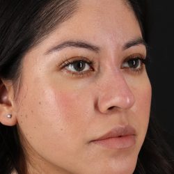 Liquid Rhinoplasty Before & After Patient #2290