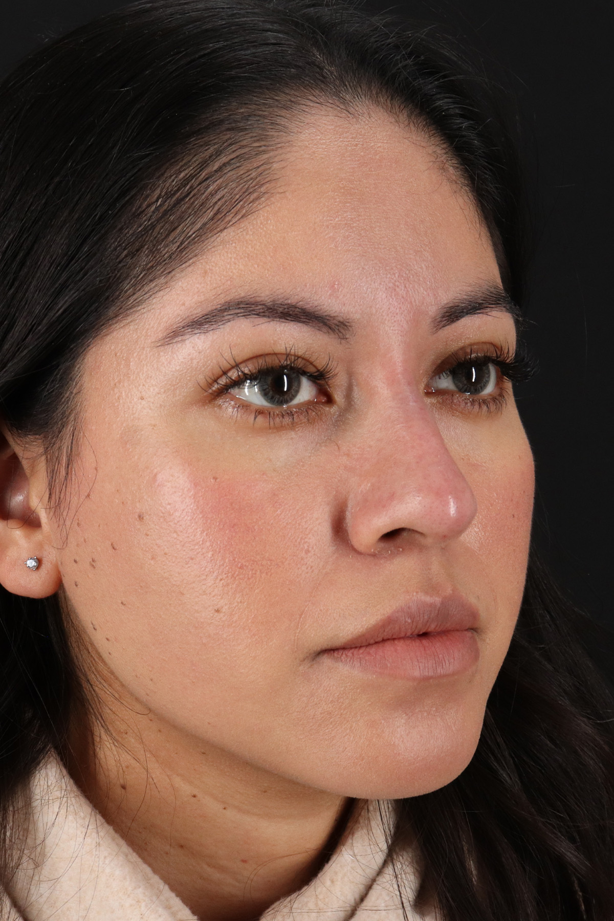 Liquid Rhinoplasty Before & After Patient #2290