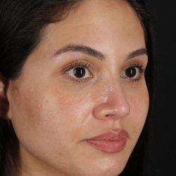 Rhinoplasty Before & After Patient #3236