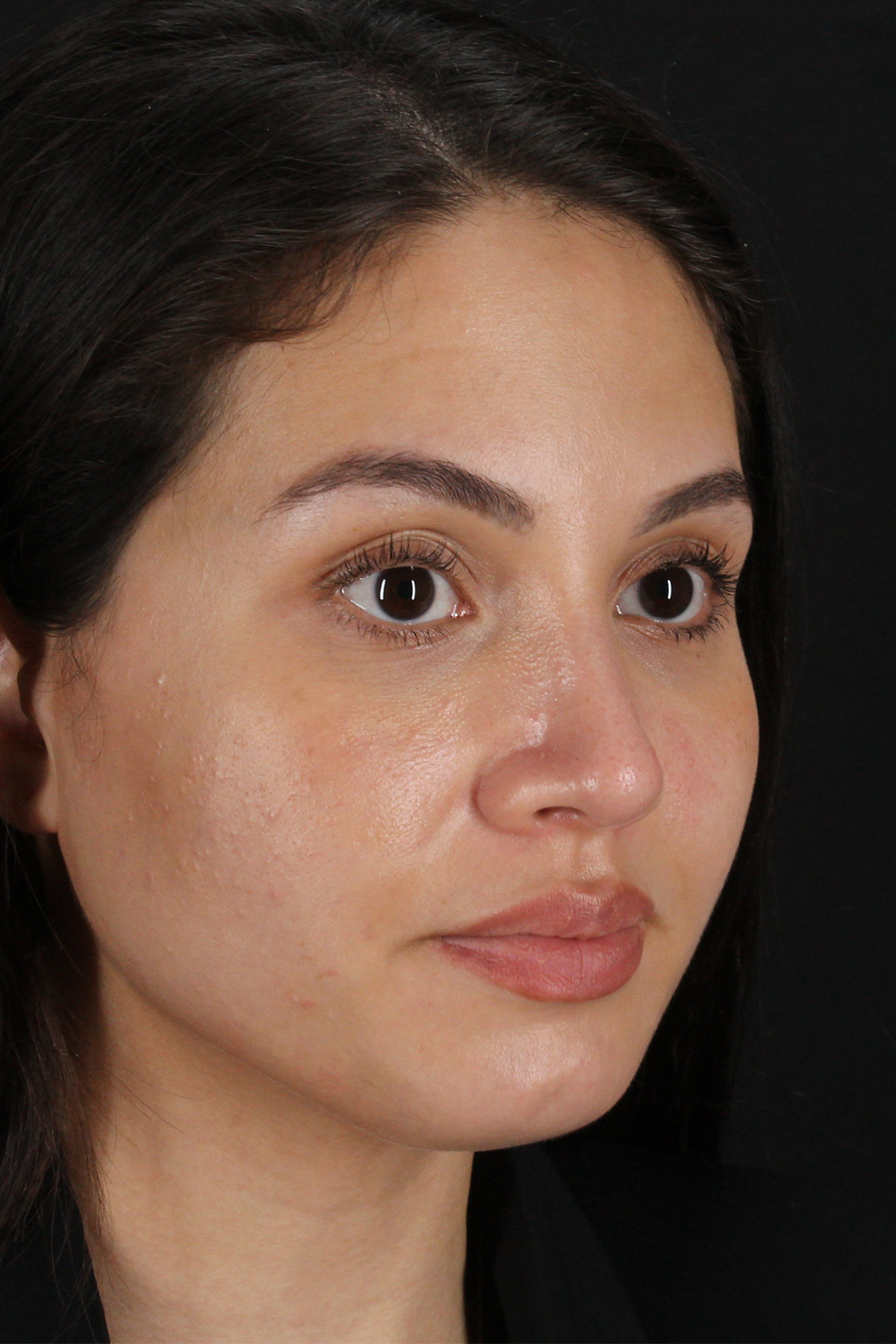 Rhinoplasty Before & After Patient #3236