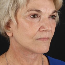 Neck Lift Before & After Patient #2648
