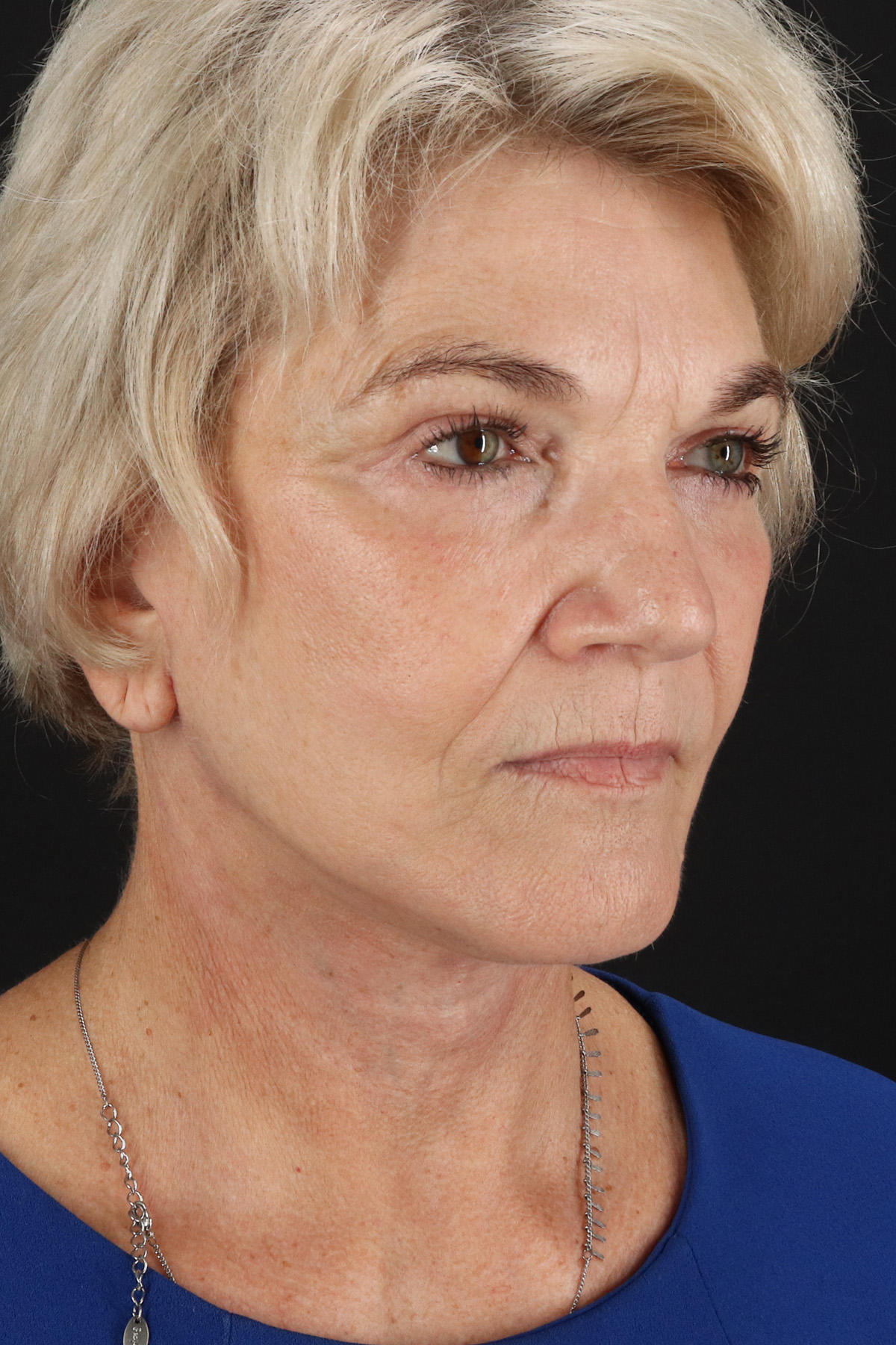 Neck Lift Before & After Patient #2648