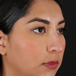 Liquid Rhinoplasty Before & After Patient #2232
