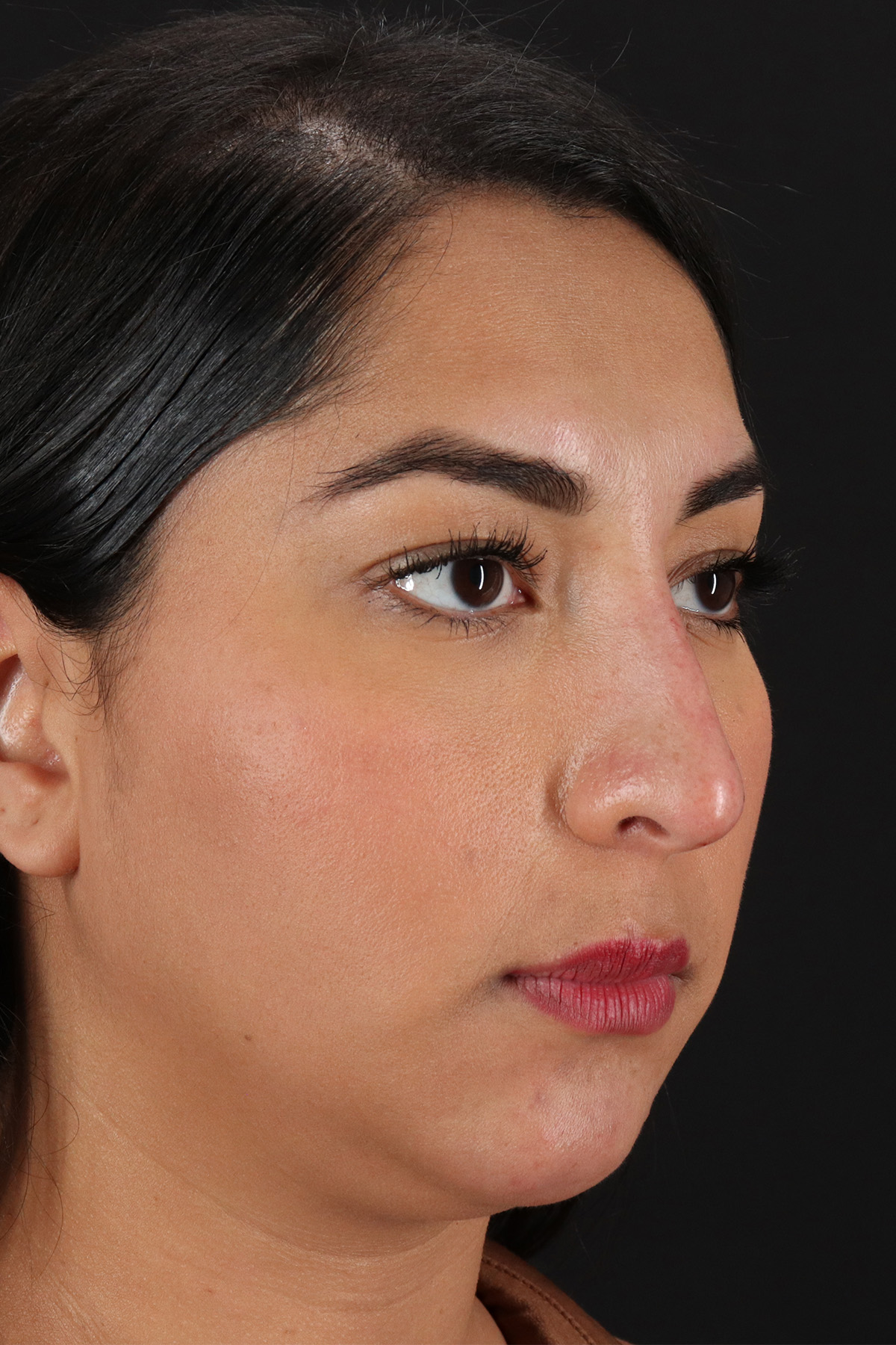 Liquid Rhinoplasty Before & After Patient #2232
