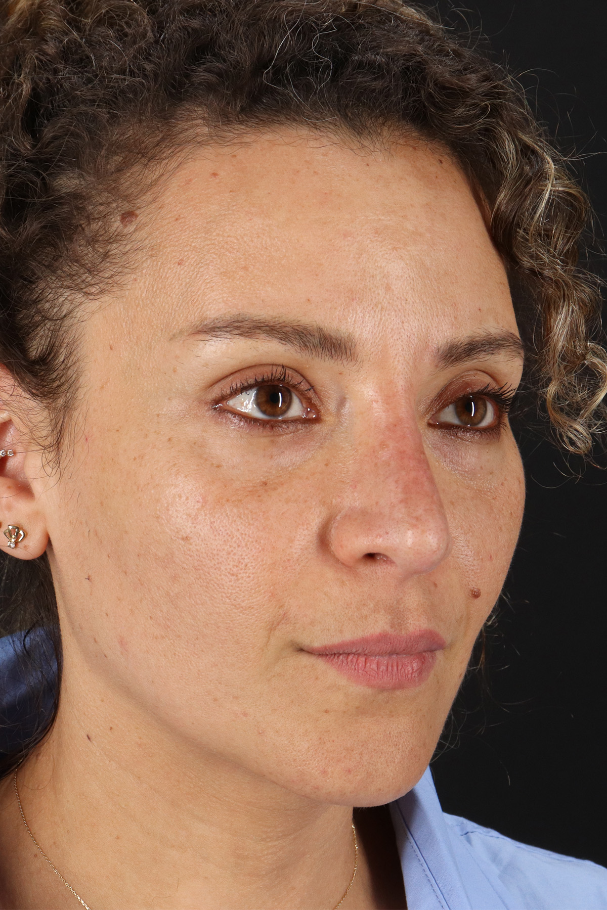 Liquid Rhinoplasty Before & After Patient #2276