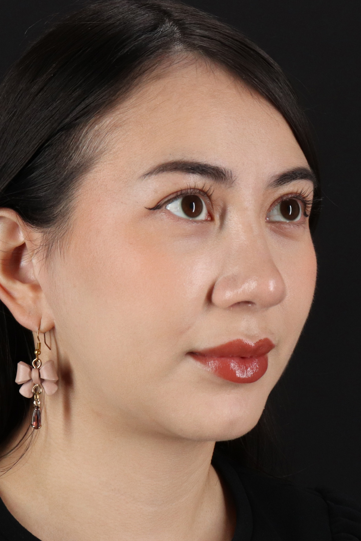 Rhinoplasty Before & After Patient #3159