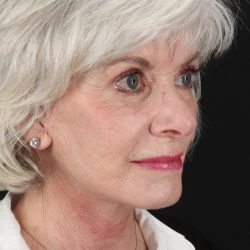 Upper Blepharoplasty Before & After Patient #5377