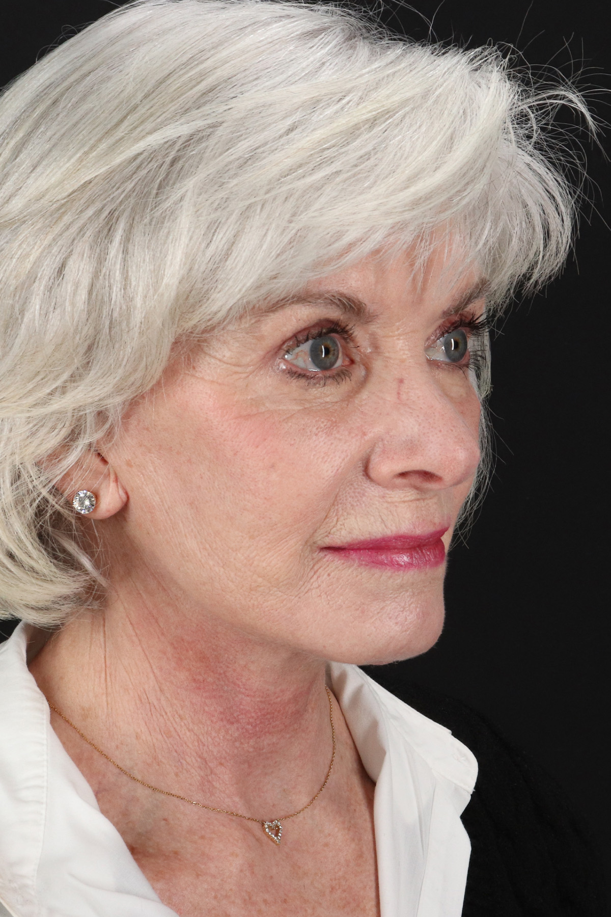 Upper Blepharoplasty Before & After Patient #5377