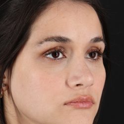 Rhinoplasty Before & After Patient #3258