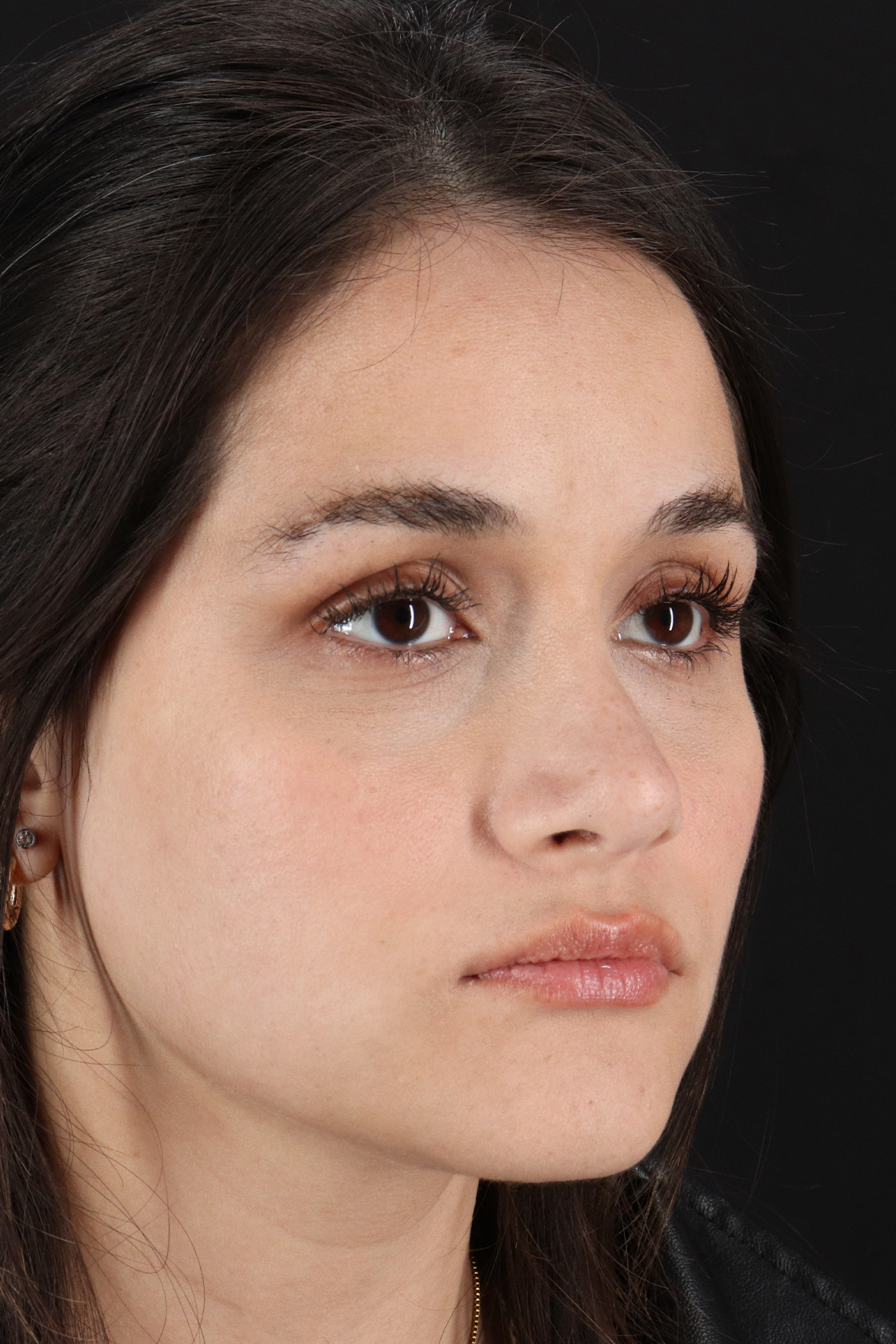 Rhinoplasty Before & After Patient #3258