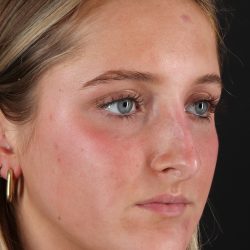 Liquid Rhinoplasty Before & After Patient #2221