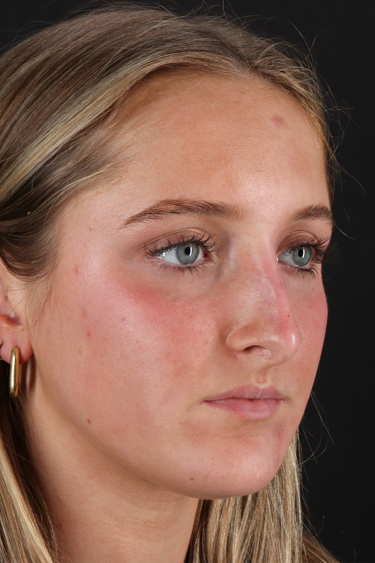 Liquid Rhinoplasty Before & After Patient #2221