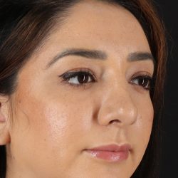 Rhinoplasty Before & After Patient #3115