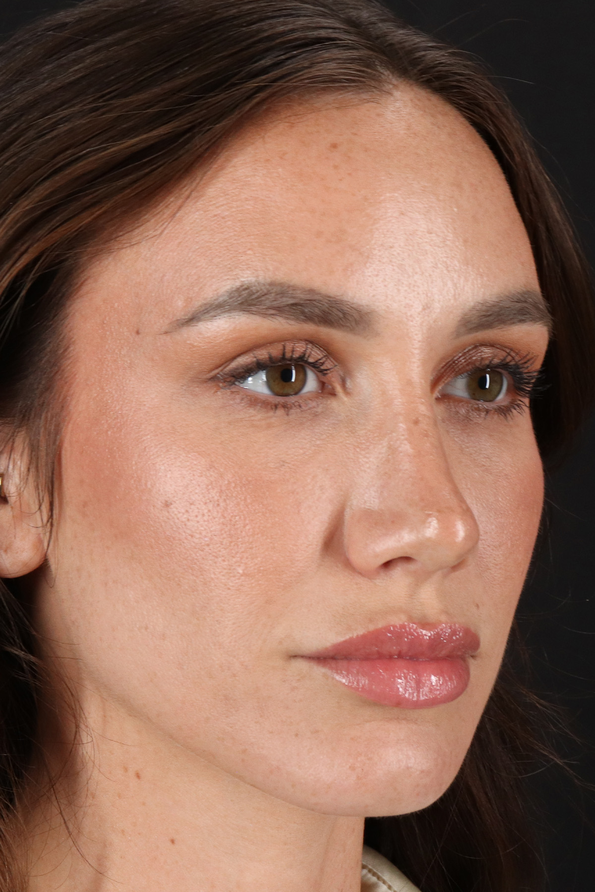 Rhinoplasty Before & After Patient #3137