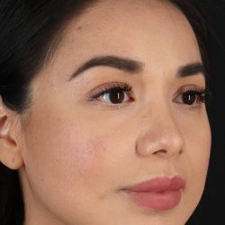 Chin Implant Before & After Patient #1626