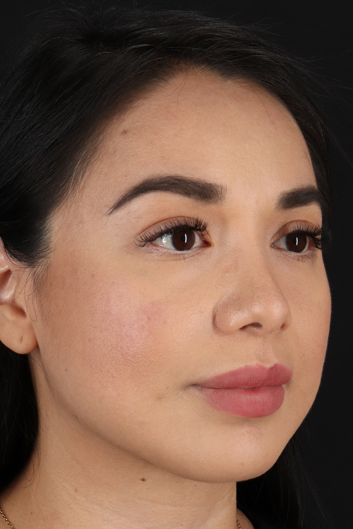 Chin Implant Before & After Patient #1626