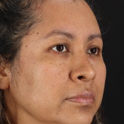 Rhinoplasty Before & After Patient #3225