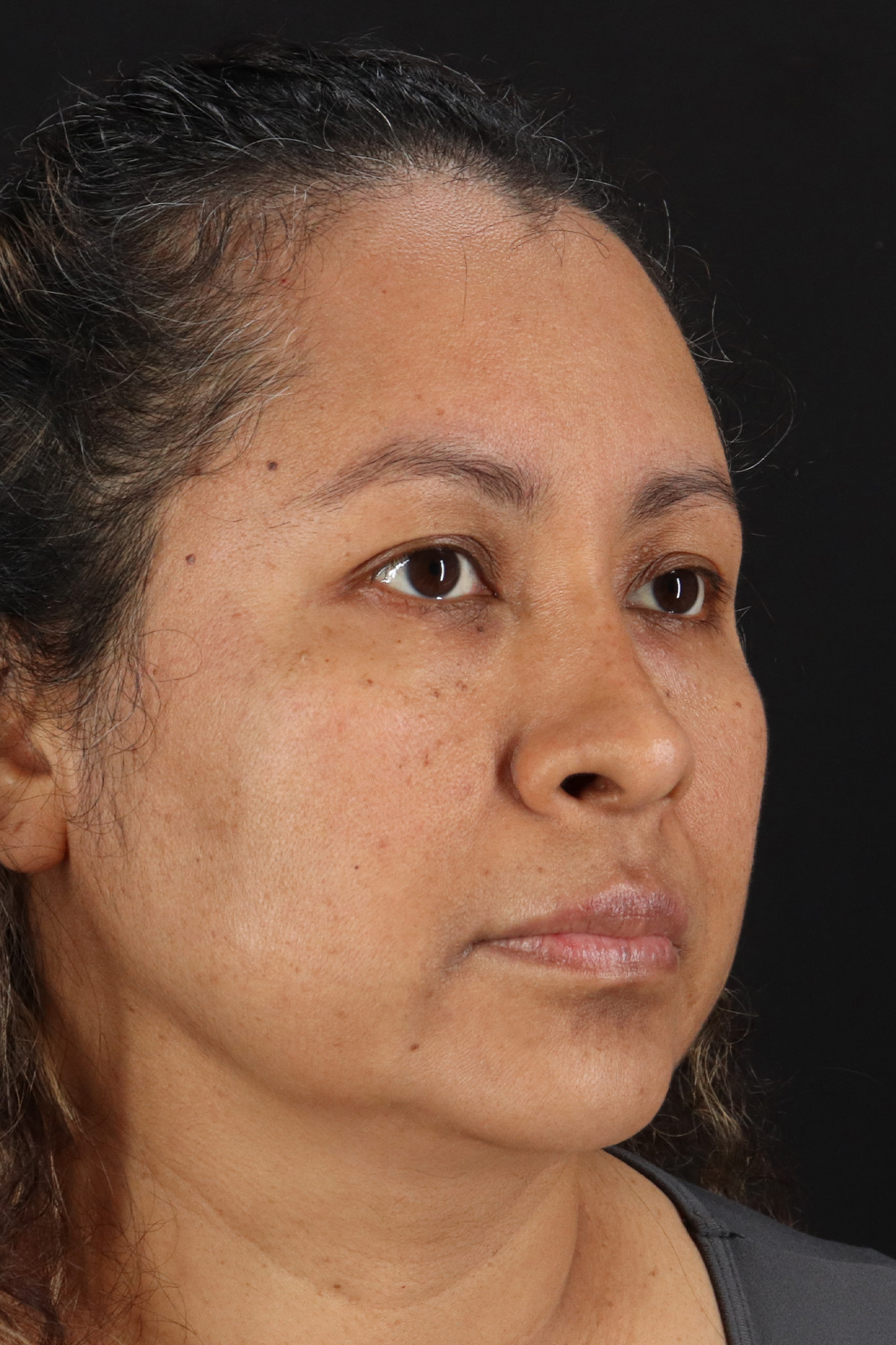 Rhinoplasty Before & After Patient #3225