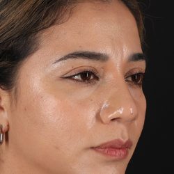 Rhinoplasty Before & After Patient #3082