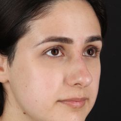 Liquid Rhinoplasty Before & After Patient #2188