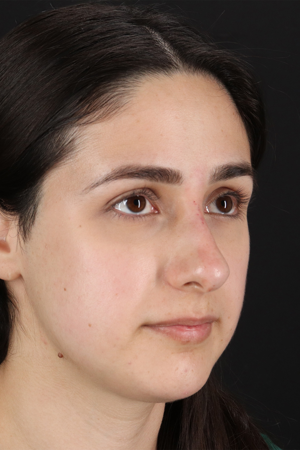 Liquid Rhinoplasty Before & After Patient #2188