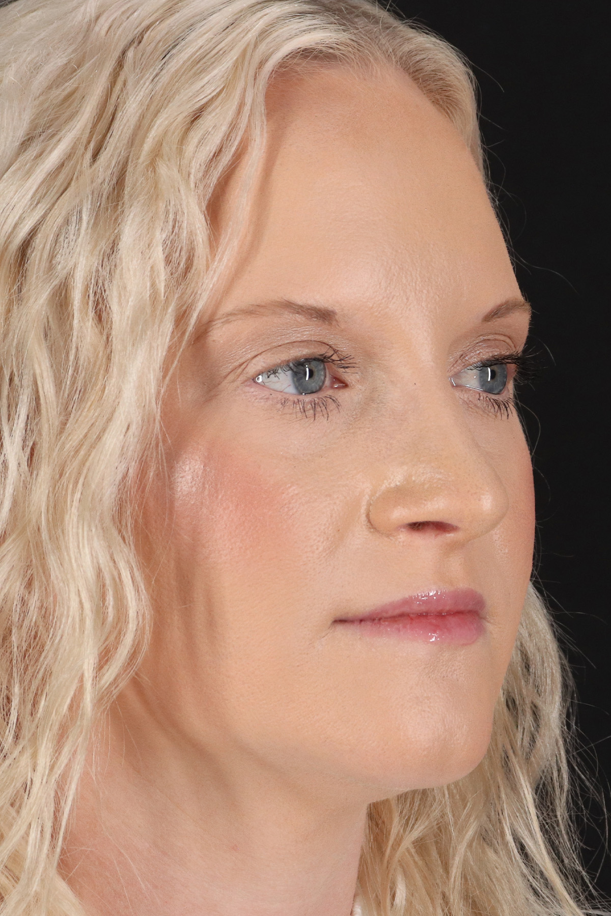 Rhinoplasty Before & After Patient #3126