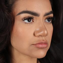 Rhinoplasty Before & After Patient #3192