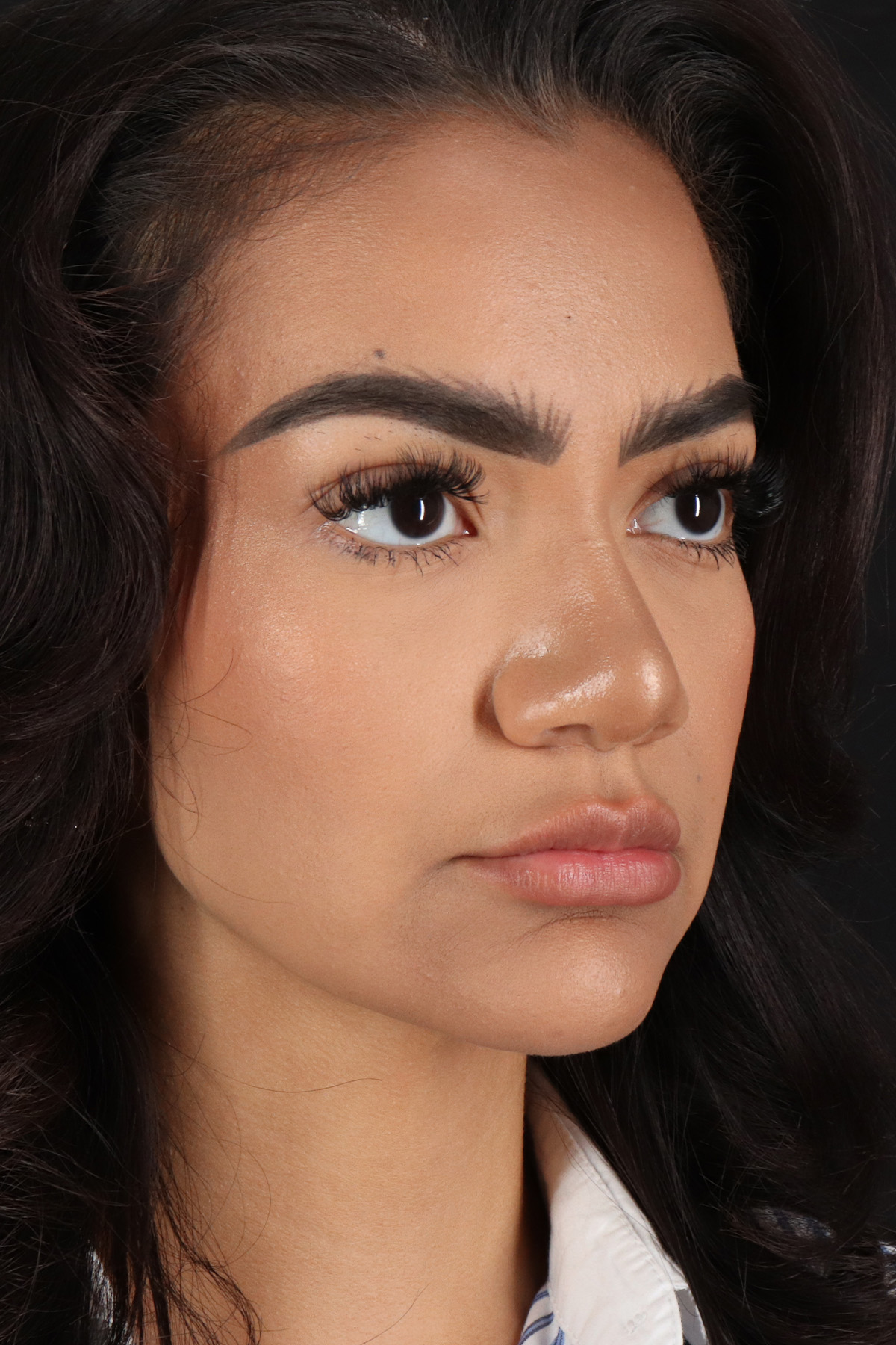 Rhinoplasty Before & After Patient #3192