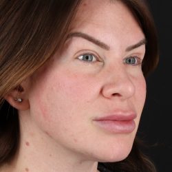 Rhinoplasty Before & After Patient #3093