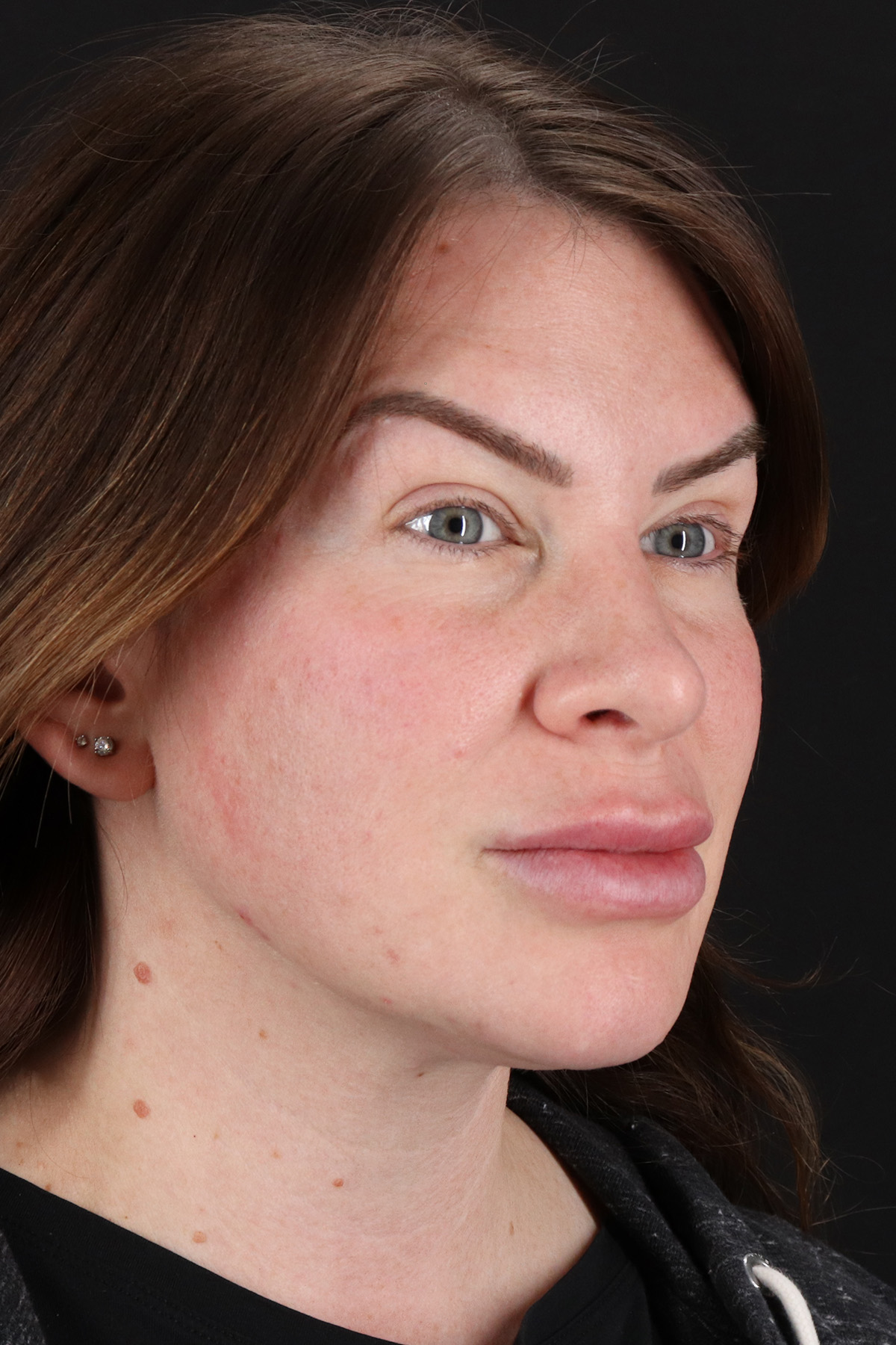 Rhinoplasty Before & After Patient #3093