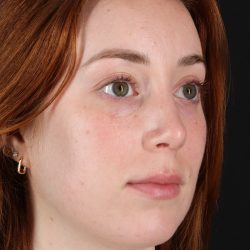 Rhinoplasty Before & After Patient #3170