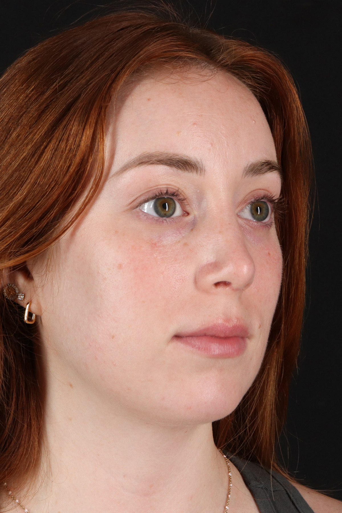 Rhinoplasty Before & After Patient #3170