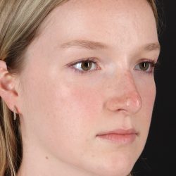 Liquid Rhinoplasty Before & After Patient #2177