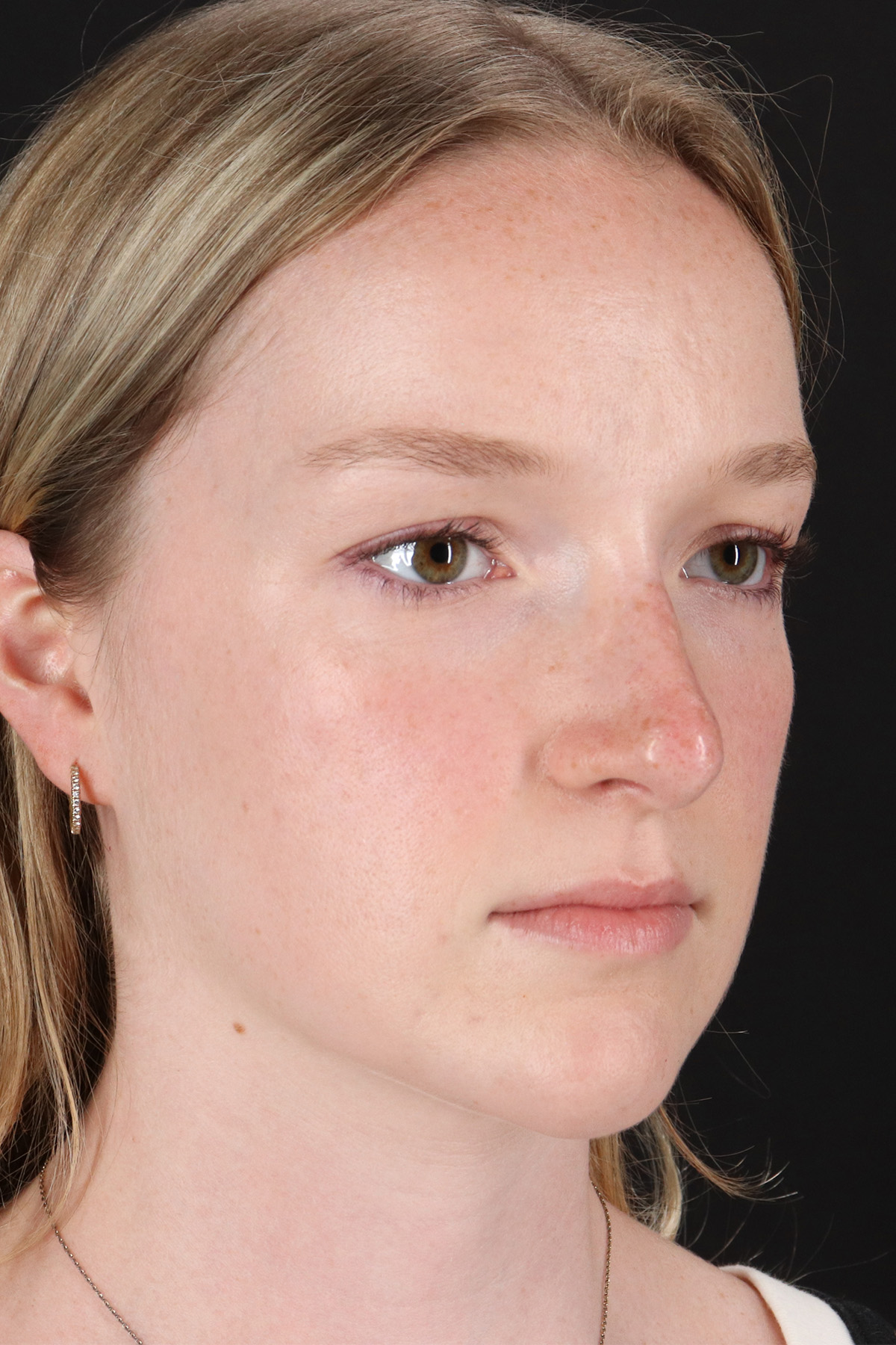 Liquid Rhinoplasty Before & After Patient #2177