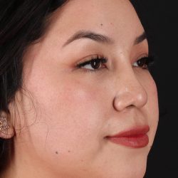 Rhinoplasty Before & After Patient #3060